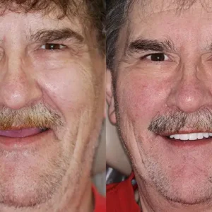 𝐁𝐢𝐤𝐞𝐧𝐝𝐚® Advanced Customized Full Denture Set