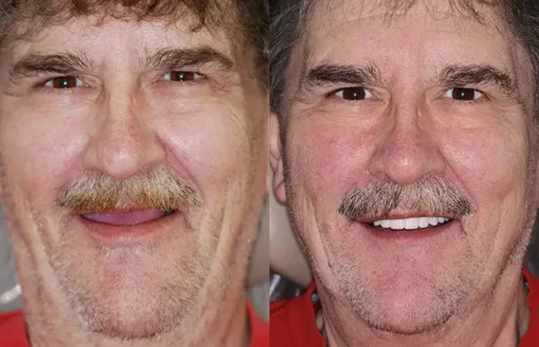 𝐁𝐢𝐤𝐞𝐧𝐝𝐚® Advanced Customized Full Denture Set