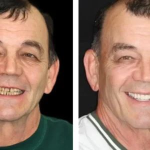 𝐁𝐢𝐤𝐞𝐧𝐝𝐚® Advanced Customized Full Denture Set