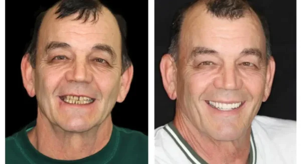𝐁𝐢𝐤𝐞𝐧𝐝𝐚® Advanced Customized Full Denture Set
