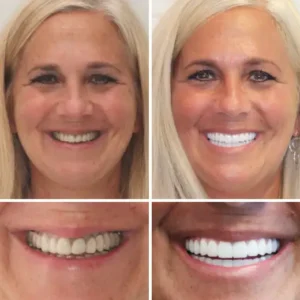 𝐁𝐢𝐤𝐞𝐧𝐝𝐚® Advanced Customized Full Denture Set
