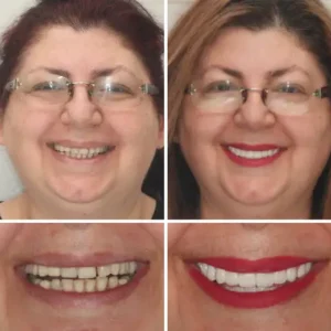 𝐁𝐢𝐤𝐞𝐧𝐝𝐚® Advanced Customized Full Denture Set