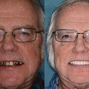 𝐁𝐢𝐤𝐞𝐧𝐝𝐚® Advanced Customized Full Denture Set