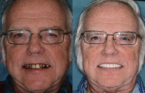 𝐁𝐢𝐤𝐞𝐧𝐝𝐚® Advanced Customized Full Denture Set
