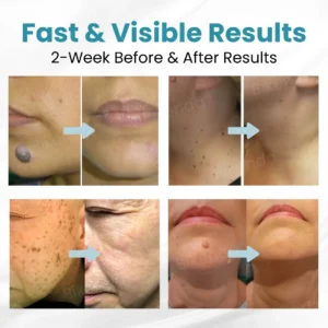 Bikenda® Non-invasive Mole and Wart