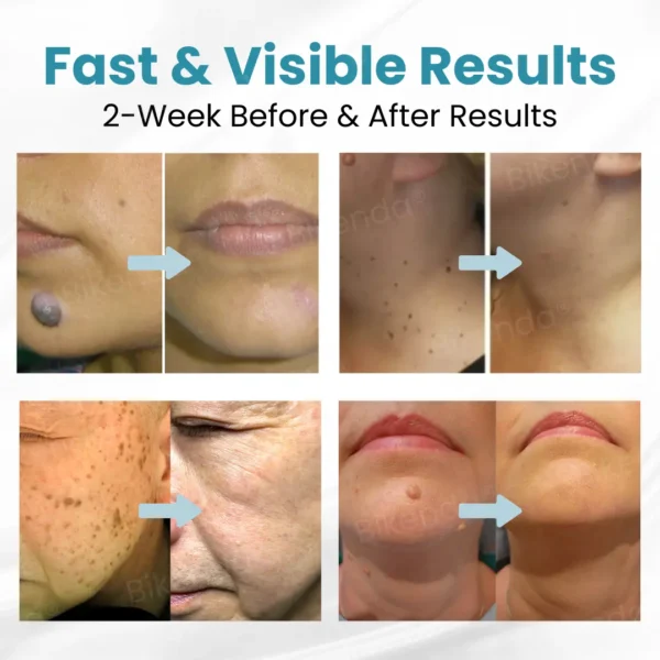 Bikenda® Non-invasive Mole and Wart